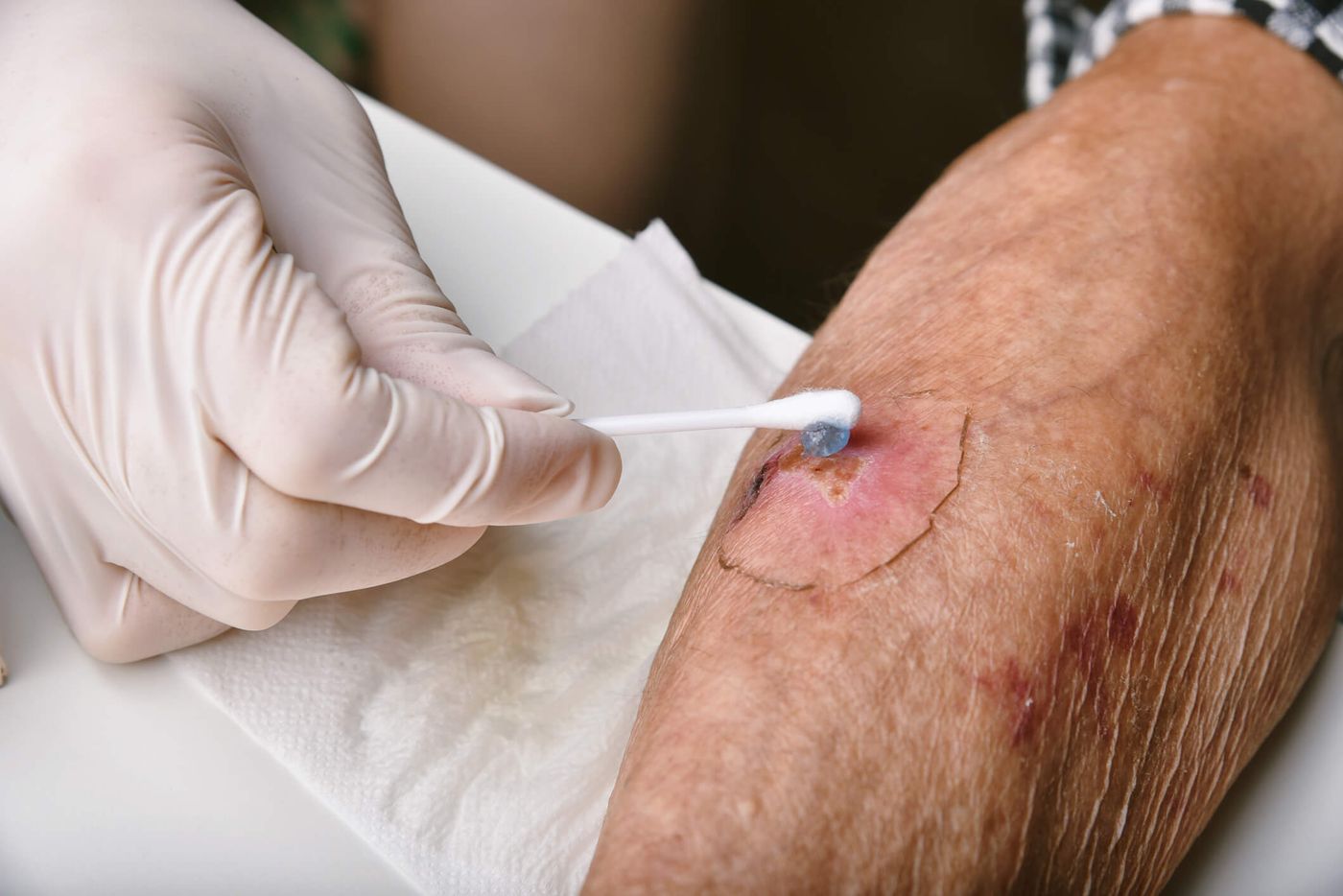 Wound Care — Care Plus Hospice